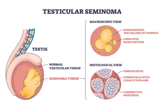 Testicular seminoma diagram explains cancer in the testis, showing a lobulated tumor mass and histology cells to clarify pathology and diagnosis, transparent background