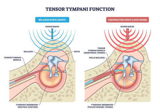 Tensor tympani function, relaxed vs contracted states show the muscle pulling the malleus to tense the tympanic membrane and protect hearing, tensor tympani, malleus, eardrum, transparent background.