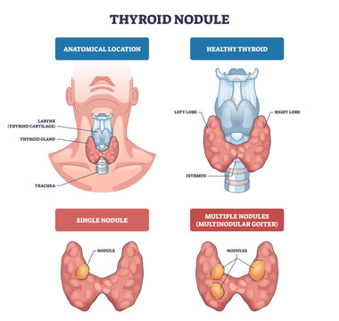 Thyroid nodules diagram compares healthy gland and nodule types, showing thyroid gland, larynx, and nodules for quick anatomy insight, transparent background