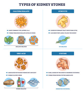 Kidney stones types chart showing calcium oxalate, uric acid, struvite, and cystine, icons of stones, labels, and arrows explain causes and diet links, transparent background