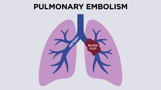 Pulmonary Embolism Blood Clot Blocking Lung Artery