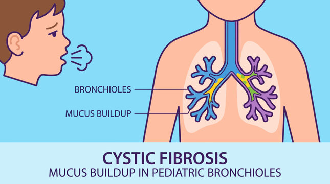 Cystic Fibrosis Mucus Buildup in Pediatric Bronchioles