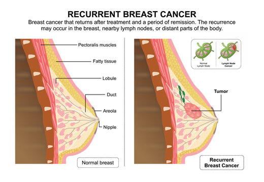 Recurrent Breast Cancer, Flashcard Illustration