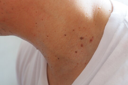 Many skin tags or Acrochordon on the neck They are small soft and common benign on the human skin especially on adult skin and can be irritated by shaving and daily clothing  