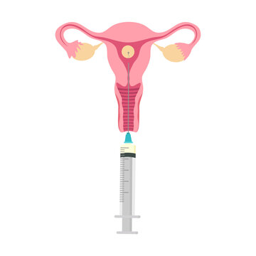 IUI treatment, Intrauterine insemination, Donor sperm service. The planing pregnant Illustration with egg cell, sperm cell good for poster medical clinic. Intrauterine insemination IUI