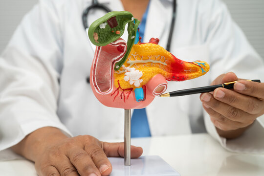 Pancreatitis, pancreatic cancer, Asian doctor with pancreas, gallbladder and bile duct human anatomy model at hospital.