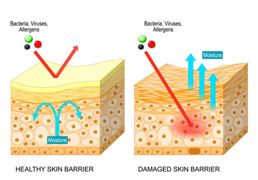 Skin barrier. Cross section of epidermis. Comparison of healthy and damaged skin barrier layers.