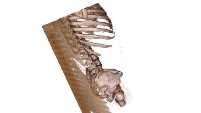 3D CT Scan Render 2 Showing Human Torso Skeleton with Severe Scoliosis Deformity Ribs Spine and Pelvis
