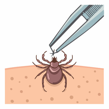 Tick Removal with Tweezers from Skin