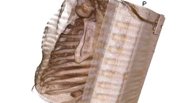 3D CT Scan Bone Reconstruction 6 Showing Human Upper Chest Skeletal Anatomy Rib Cage Clavicle and Shoulder Joint