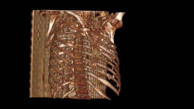 3D CT Reconstruction of Human Thoracic Skeleton Showing Rib Cage, Clavicles and Shoulder Anatomy