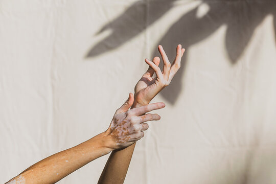 Caucasian woman's' hand with vitiligo 