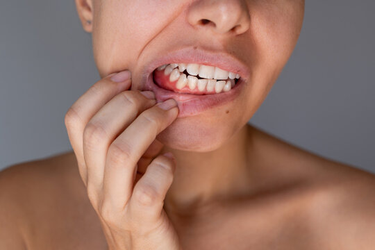 Close-up of a young woman touching irritated gums and showing dental discomfort on a grey background. Oral health, gum inflammation and tooth pain concept