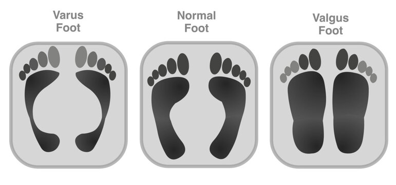 Knee vargus, valgus and normal footprint, feet deformity for orthopedic shoes. Knee collapses inwards towards the mid line of the body. Illustration vector	
