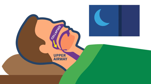 Sleep Apnea Upper Airway Collapse During Nighttime Breathing