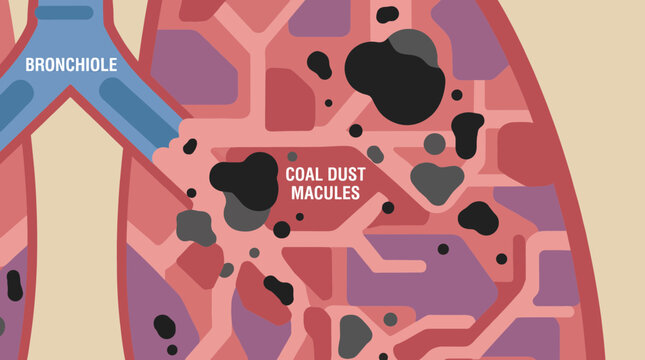 Pneumoconiosis Coal Dust Macules in Miner Lung Tissue