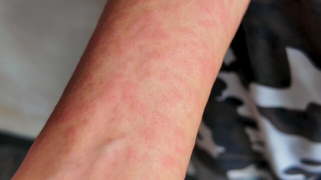 Close up of severe skin rash and allergy on man arm