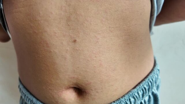 Close up of red skin rash on child stomach and abdomen