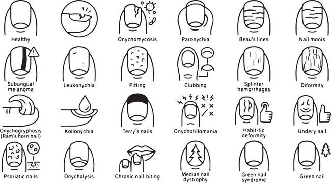 Nail Diseases, Dermatology Disorders, and Finger Nail Conditions Vector Line Icons Set (Includes Onychomycosis, Subungual Melanoma, Paronychia, Koilonychia, and Chronic Nail Biting Concepts)