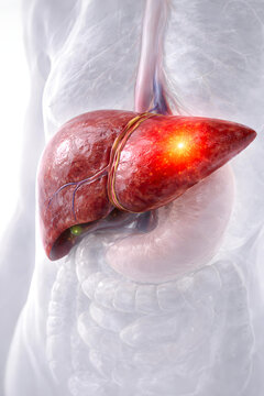 Liver anatomy disease inflammation human organ pain, medical illustration showing glowing liver injury inside torso with vessel detail