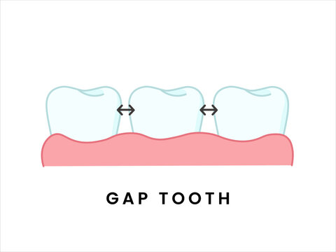Gapped Teeth Dental Condition Illustration. Diastema Tooth Alignment Flat Dental Icon.