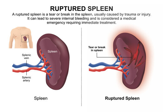 Ruptured Spleen, Educational Flashcard Illustration