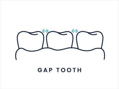 Gapped Teeth Dental Condition Outline Icon. Diastema Tooth Alignment Flat Dental Icon.