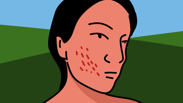 Rash on a young woman's face, color vector illustration