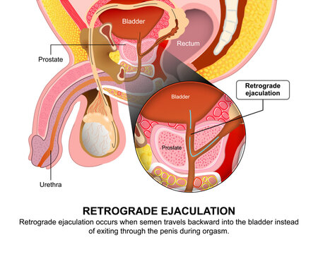 Retrograde Ejaculation, Male Flashcard Illustration