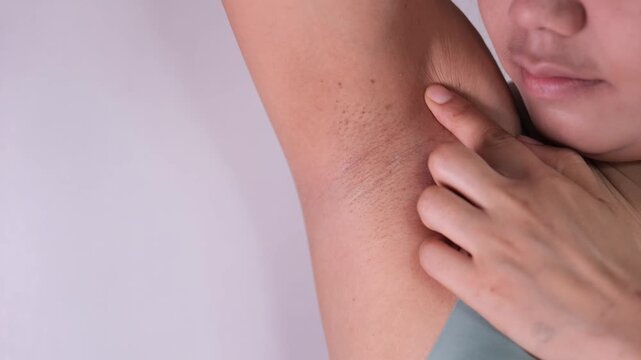 Close-up of Women armpit with problem black armpit. Dark and wrinkle armpit from deodorant allergic, 4k video