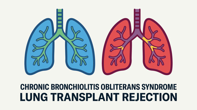 Lung Transplant Rejection Chronic Bronchiolitis Obliterans Syndrome