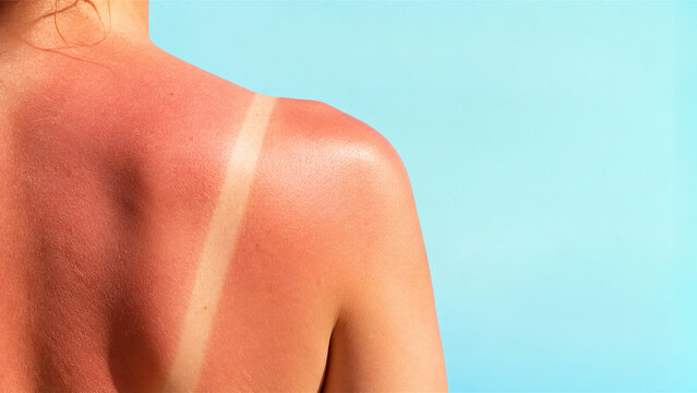 woman with severe sunburn on shoulder showing tan line. Skin damage from ultraviolet sun exposure. Concept of summer safety, dermatology, lifestyle healthcare and skincare protection