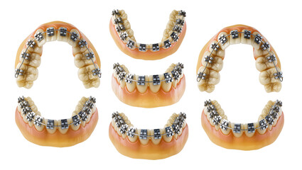 Isolated dental models with lingual braces on back of teeth for orthodontic treatment. © Oisin