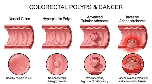 Visualizing Colorectal Polyps and Cancer Progression From Normal Colon to Invasive Adenocarcinoma