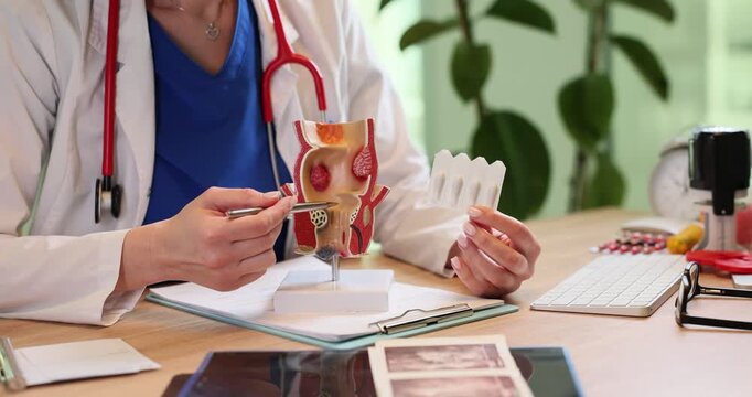Doctor shows human rectum model and suppositories in hospital. Woman proctologist explains hemorrhoids treatment at appointment in clinic slow motion