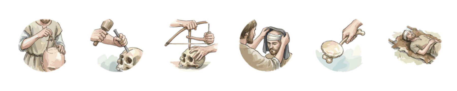 Ancient surgical procedures depicted through historical illustrations of trepanation