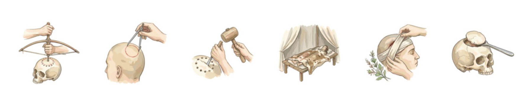 Historical surgical techniques for trepanation and skull procedures