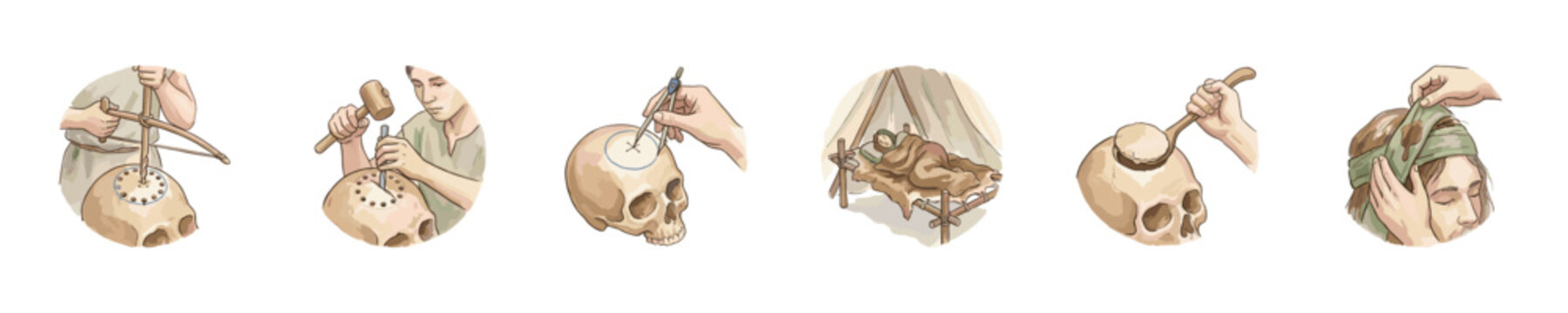 Ancient surgical procedure of trepanation depicted in stages