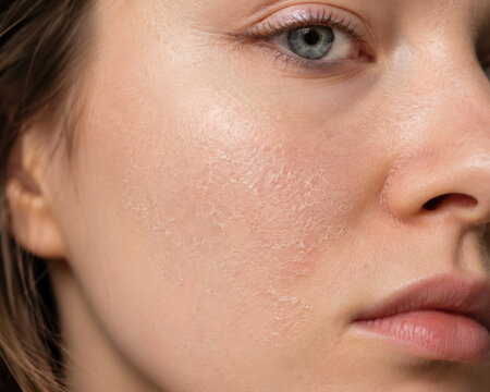 Close Up of Dry Flaky Facial Skin on Woman Face Showing Dehydration and Skin Barrier Damage