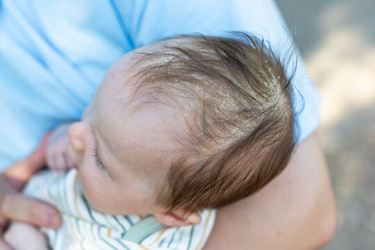 Close-up of a newborn baby&rsquo;s scalp with cradle cap, showing dry flaky skin on the head during a gentle infant care moment