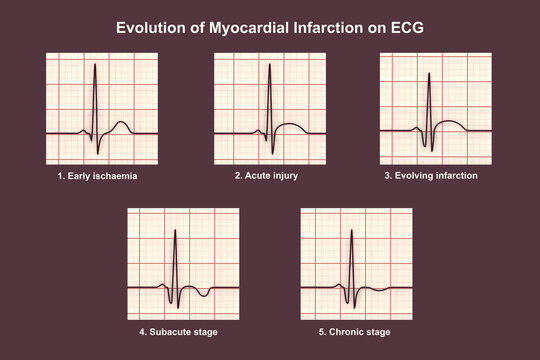 Evolution of myocardial infarction on ECG, 3D illustration showing stages from hyperacute T wave to chronic pathological Q wave changes.