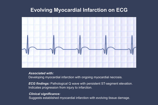 Electrocardiogram showing pathological Q wave with ST-segment elevation, 3D illustration of ECG trace indicating acute myocardial infarction.