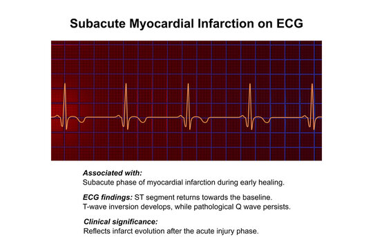Subacute stage of myocardial infarction, 3D