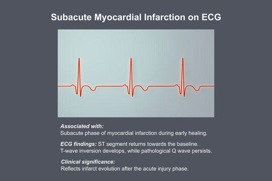 Subacute stage of myocardial infarction, 3D