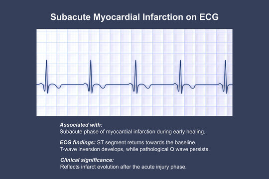 Subacute stage of myocardial infarction, 3D