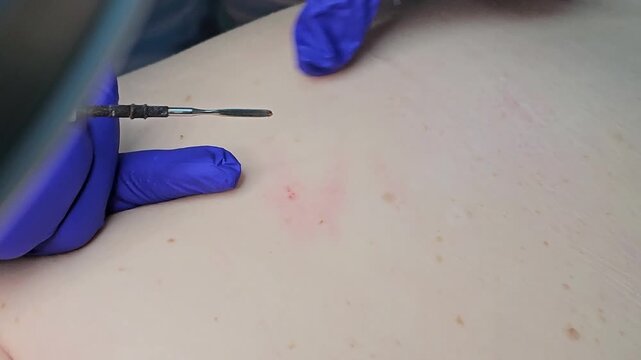 Doctor removing small papillomas with electrocoagulator during dermatology procedure in clinic