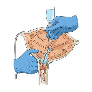 Medical illustration of a lumbar puncture or spinal tap procedure showing a needle being inserted into the spinal canal of a human patient, anatomical cross-section diagram style.