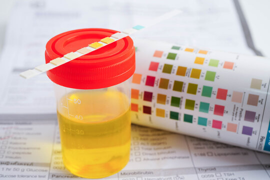 Urinalysis, urine cup with reagent strip pH paper test and comparison chart in laboratory.