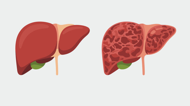 Health illustration compares the appearance of a normal healthy liver with a diseased organ affected by cirrhosis or chronic illness.