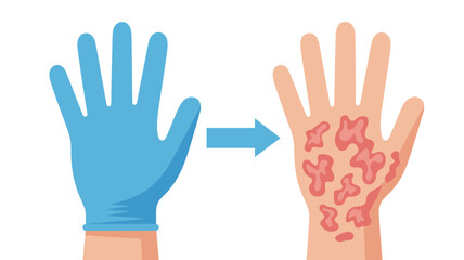 Fototapeta premium Visual guide shows the removal of a medical glove to reveal a red skin rash or allergic reaction on a person's hand for health education.
